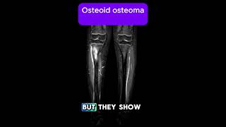 Osteoid osteoma [upl. by Attenahs649]