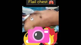 flail chest 🧰 traumatic injury to the chest rib cage medicine Sudarshanlipane17 🩺🩺🩺🏥🏥🩺🩺⛑️⛑️⛑️ [upl. by Fagen]