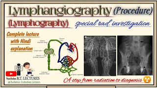 Lymphangiography Lymphography special investigation in hindi Lymphography complete investigation [upl. by Suirad191]