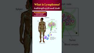 What is LymphomaCauses and Treatmentబ్లడ్ క్యాన్సర్lymphoma hodgkinlymphoma nonhodgkinlymphoma [upl. by Nathaniel]