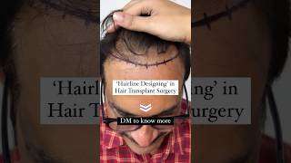 ‘Hairline Designing’ in Hair Transplant Surgery  Natural Hairline  Hair Transplant  Dr Pragati [upl. by Saeger]