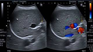 Ultrasound case of cavernous transformation Of portal vein with aneurysm varix [upl. by Nylynnej]