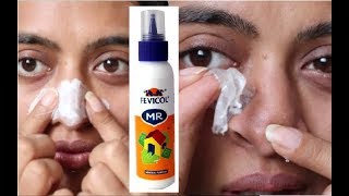 Can Fevicol Remove Blackheads  Viral DIY Tested  remove blackheads with fevicol for blackheads [upl. by Smith631]