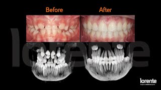 Caso clínico de tratamiento para supernumerarios intervención y ortodoncia fija [upl. by Muncey339]