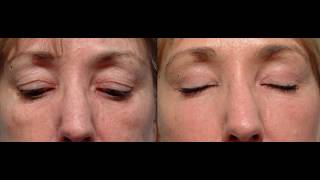 Blefaroplastia sin cirugía  Plasma Láser  Clínica Estética Vicario [upl. by Aya]