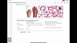 leukemoid reaction vs cml haematology 89 First Aid USMLE Step 1 in UrduHindi [upl. by Llehsad]