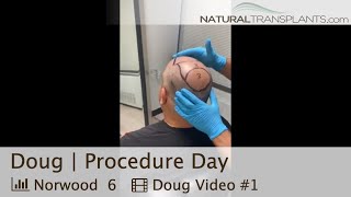 Norwood 6 Hair Transplant Procedure Day With Tons of Density  Dr Blumenthal Doug [upl. by Yedarb]