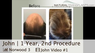 Norwood 3 Hair Transplant Results After Second Coat of Paint  Dr Blumenthal John [upl. by Latisha415]