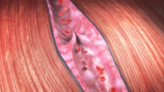 blood clot animation [upl. by Rebeh27]