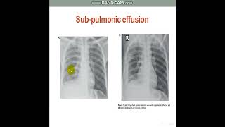 PleuralEffusionDiagnosticApproach [upl. by Jabon]