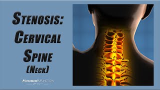 Cervical Spine Stenosis  Best Exercises to Decrease Pain and Other Symptoms [upl. by Eetak]