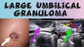 Large Umbilical Granuloma  Umbilical Swelling Ultrasound [upl. by Annai383]