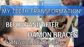 MY TEETH TRANSFORMATION  BEFORE AND AFTER BRACES [upl. by Etneciv]