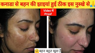 10 साल पुरानी Pigmentation से 3 महीने में 90 छुटकारा💯मेरी झाइयां चली गई बस चीज लगाईgorahonekatrika [upl. by Aicrop470]