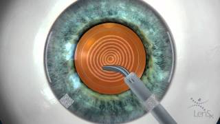 Stephen Slade MD Laser Cataract Surgery Animation [upl. by Alaj]