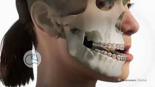 Orthognathic Surgery Underbite [upl. by Nivlag]