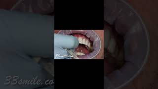 Correcting discolored teeth with prepless veneers before and after [upl. by Ednutey175]