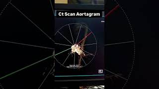 A CT Coronary Angiogram can identify calcification 👨‍⚕️👨‍💻 trendingshorts viralshorts video [upl. by Klockau]