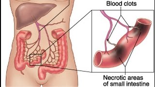 Mesenteric Ischemia [upl. by Hait]