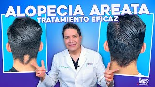 TRATAMIENTO EFICAZ PARA ALOPECIA AREATA [upl. by Lud]