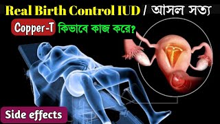 How IUD Works to Prevent Pregnancy Animation। Copper T Insertion and Side Effects । [upl. by Uchida956]