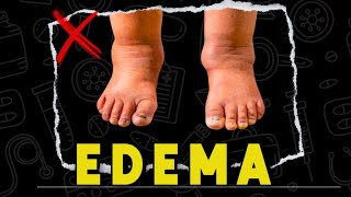 🤔Unlock the Secrets of Edema Is Your Body Holding Water 💧edema [upl. by Madella746]