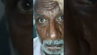 iris coloboma atseyecare drmaateeq eyecare eyes iris indian oldage congenital sincebirth [upl. by Llertrac534]