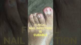 Fungal Nail Infection Is Curable podiatry feet footcare fungaltoenails curentaffairs2022 [upl. by Arriet403]