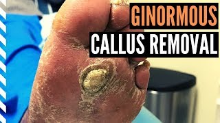 Ginormous Callus Removal [upl. by Drofnats830]