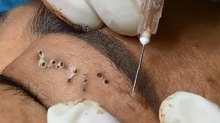 Big Cystic Acne Blackheads Extraction Blackheads amp Milia Whiteheads Removal Pimple Popping [upl. by Liuqnoj431]