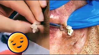 Ultimate Blackhead amp Acne Removal Compilation 😷🔥 PimplePopping SkinCare [upl. by Akkina]