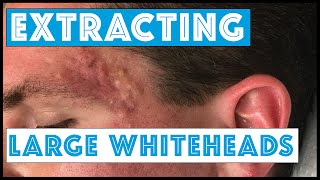 Acne Vulgaris and Extracting large Whiteheads  Part 1 [upl. by Rawna]