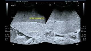 Ultrasound video showing retroplacental hemorrhageplacental abruption [upl. by Nepean]