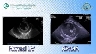 050 Regional LV Function RWMA TEE KAMC [upl. by Hortensa630]