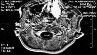 Stevens Brain MRI 21609 [upl. by Harshman270]