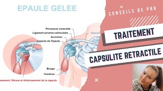 Traitement capsulite rétractile [upl. by Eeliram]