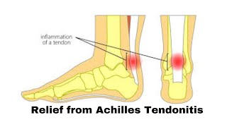 Relief from Achilles Tendonitis [upl. by Assiran]