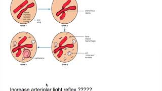 1 Hypertensive Retinopathy2Hypertensive retinopathy stages httpsyoutubeOIvLfj95o [upl. by Allebram]