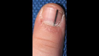 Dermatology Wk8WedSpr20 Anatomy of the Nail Then Learn About Melanonychia [upl. by Ytissac]