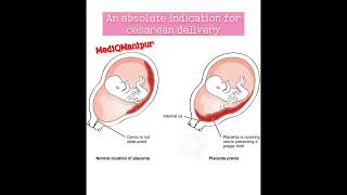 Placenta previa Cesarean sectiondoctor anatomy obstetrician nursing medicalstudent [upl. by Leunas]