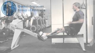 Benefits of Osseointegration  Patient Video [upl. by Perron492]