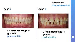 Symposium on stage IIII periodontitis treatment guideline  Yaman Altaep from Liège [upl. by Teiluj]