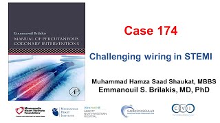 Case 174 Manual of PCI  Challenging wiring in STEMI [upl. by Dawaj816]