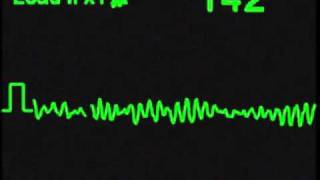 Ventricular Fibrillation  VFIB  ECG Simulator  Arrhythmia Simulator [upl. by Sudnak]