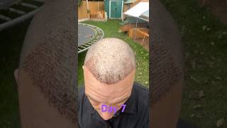 Day 7 Join My Hair Transplant Journey Real Results amp Recovery [upl. by Chatav]