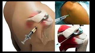 5 seconds trick to get pain free shoulderFrozen shoulderIntraarticular injection technique [upl. by Arta]