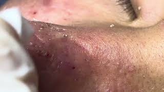 Acne treatment Thu 90 Da Nang  new 112024 [upl. by Ydde600]