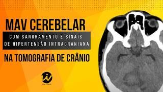 MALFORMAÇÃO ARTERIOVENOSA MAV CEREBELAR com Sangramento e Sinais de Hipertensão Intracraniana [upl. by Yirinec]