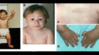 Pediatric hematology  Fanconi Anemia [upl. by Siloa]