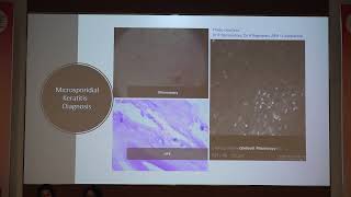 AIOC2022 IC192 Topic Dr M VANATHI CHALLENGES IN MANAGING MICROSPORIDIAL KERATITIS [upl. by Gordon]